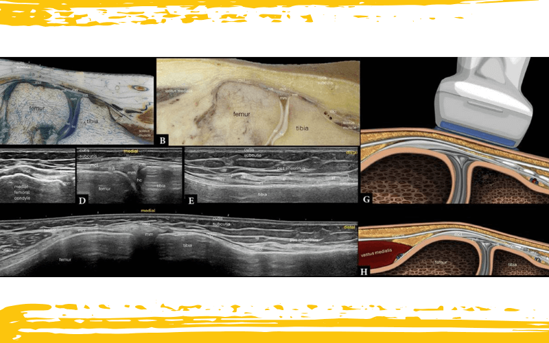 2. Compartimento medial rodilla ecografia tempo formacion.png